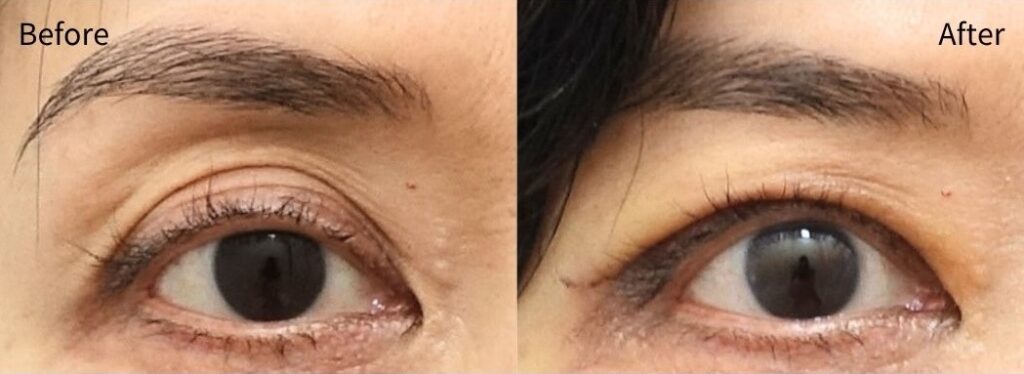 high fold eyelids appearing deeper due to hollow upper eyelid before and after correction