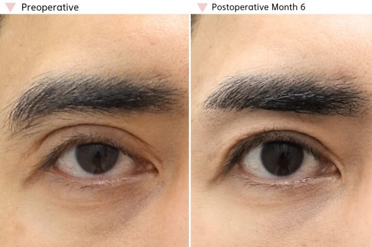Before and 6-month postoperative result after ptosis revision surgery showing improved eyelid opening and stable eyelid function.