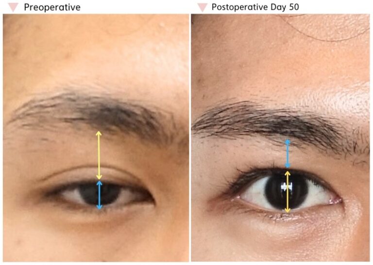 High fold revision before and after showing a lower, more natural eyelid crease and improved eye opening after revision surgery.
