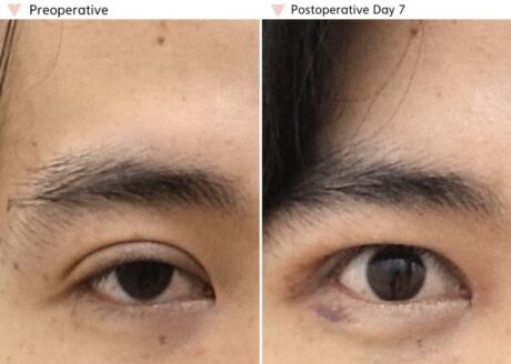 Ptosis Surgery: Why Making the Crease Higher Does Not Always Improve Eye Opening