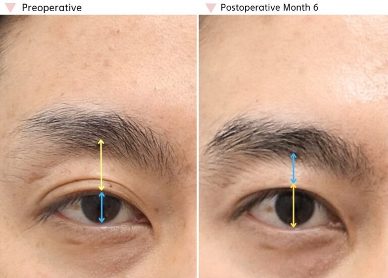 High fold revision before and after showing improved functional eye opening and a more balanced eyelid crease after revision surgery.