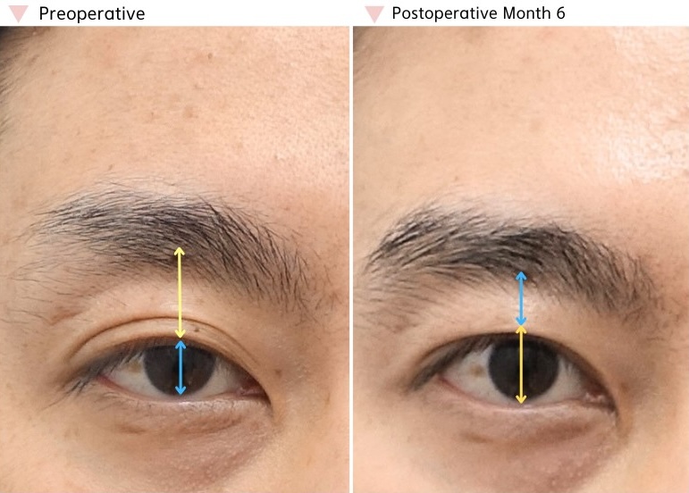 High fold revision before and after showing improved functional eye opening and a more balanced eyelid crease after revision surgery.
