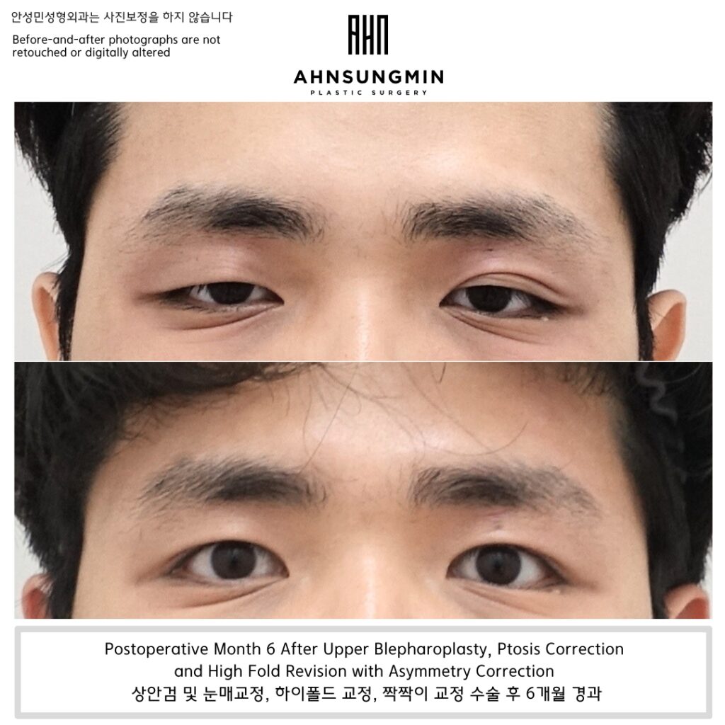 Why High Fold Correction Required Structural Adjustment—Not Just Lowering the Crease.