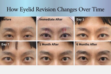 High Fold Eyelid Revision with Ptosis Correction | 6-Month Result