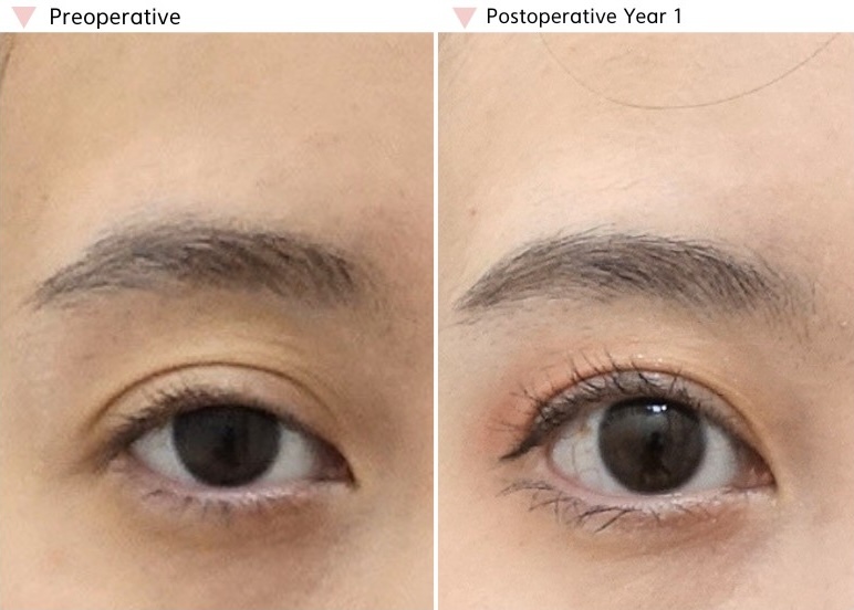 High fold revision before and after showing a lower, softer, and more naturally balanced eyelid crease one year after revision surgery.