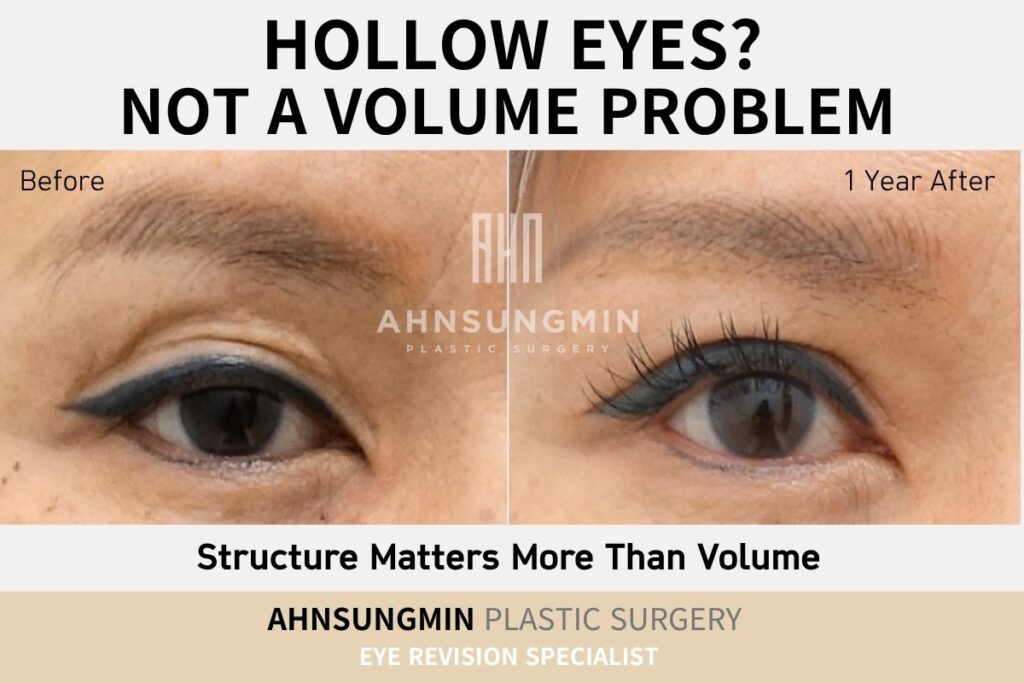 Hollow Eyes After Surgery? It’s Not a Volume Problem