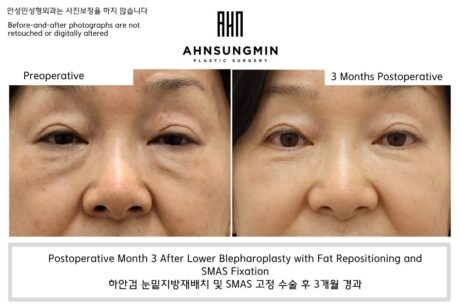 Why Does My Under-Eye Look Hollow After Lower Eyelid Surgery?