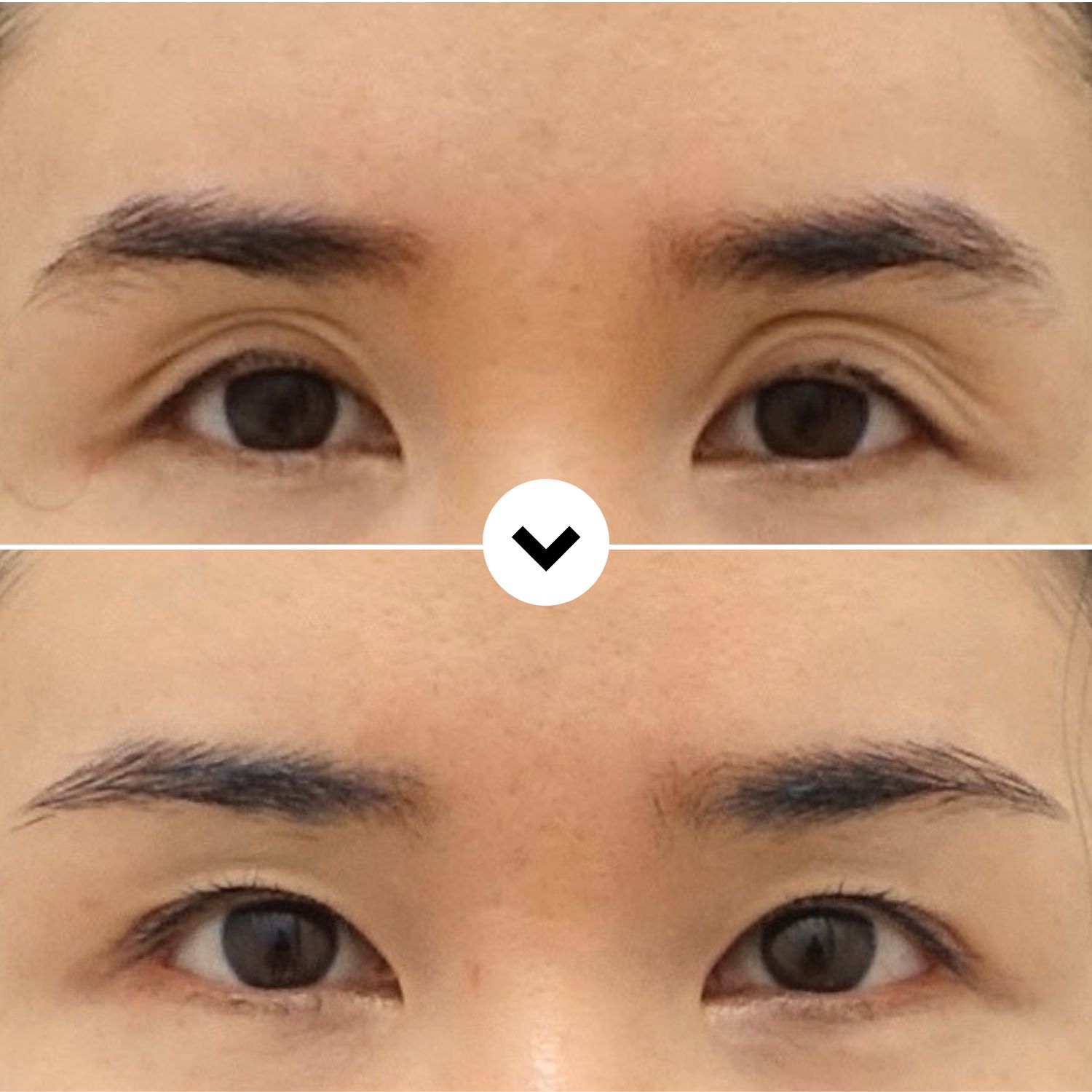 Before and after hollow upper eyelid revision surgery showing improved upper eyelid volume, smoother contour, and a natural appearance.