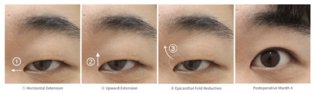 How Epicanthoplasty Creates a More Open Appearance.