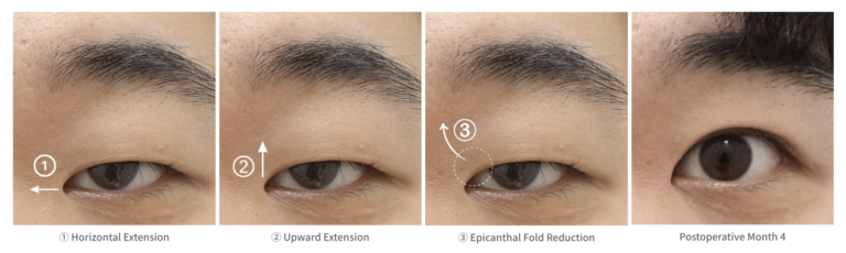 Illustration showing how epicanthoplasty creates a more open eye appearance through horizontal extension, upward extension, epicanthal fold reduction, and postoperative results at 4 months.