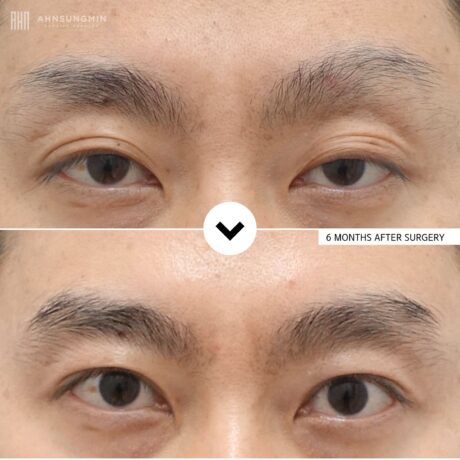 How to Choose a Korean Eye Surgeon