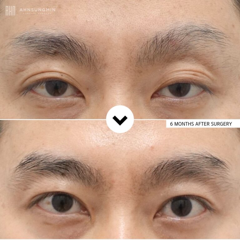 Before and after upper eyelid surgery with ptosis correction showing natural eye opening, balanced eyelids, and harmonious facial appearance six months after surgery.