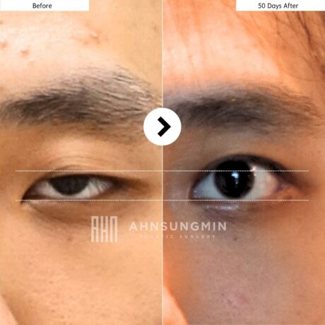 Why Ptosis Can Cause Multiple Eyelid Folds
