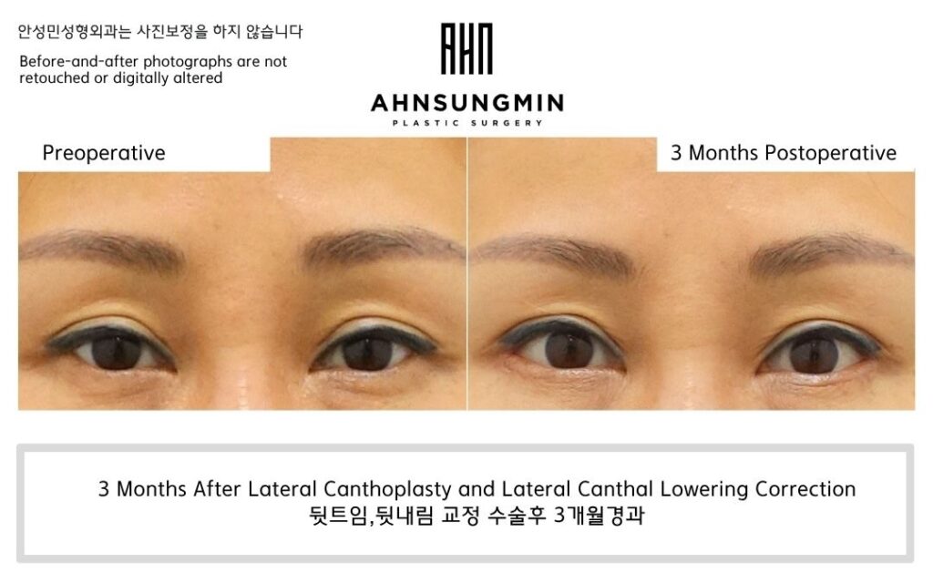 lateral canthoplasty and lateral canthal lowering correction before and after 3 months showing improved eye shape balance and natural outer corner position