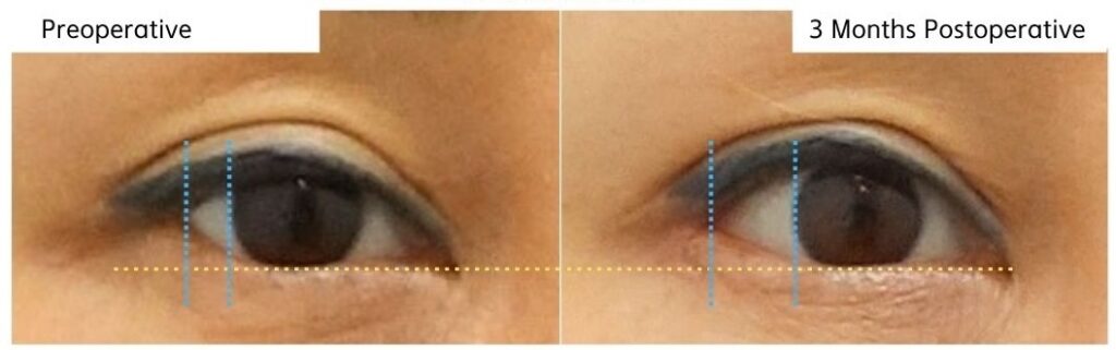 close-up comparison of lateral canthal lowering correction before and after 3 months showing improved outer eye corner position and alignment