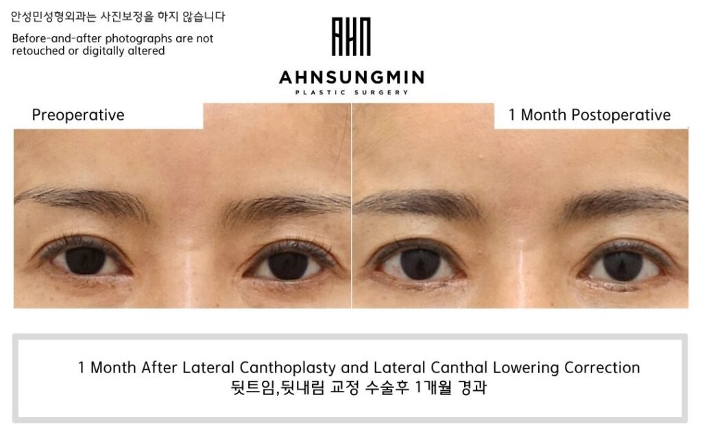 lateral-canthoplasty-1-month-before-after-full-face-korea.jpg