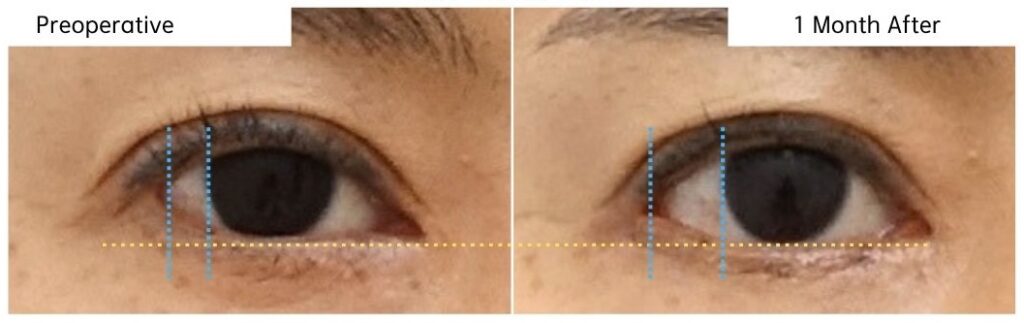 lateral-canthoplasty-1-month-close-up-eye-width-expansion-korea.jpg