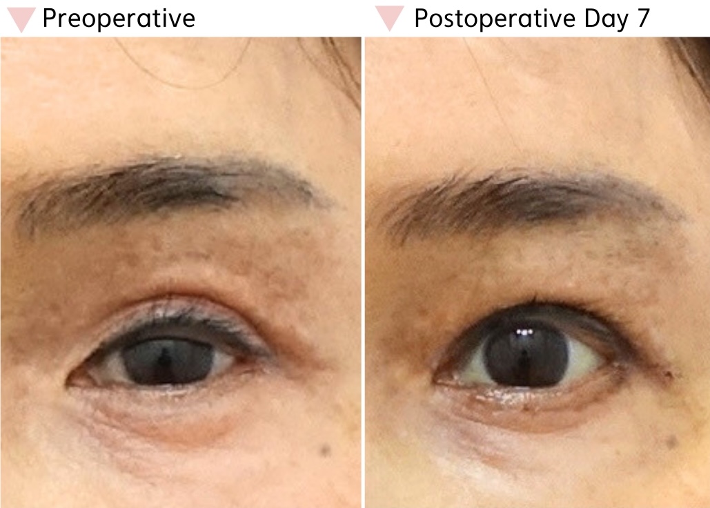 Postoperative Day 7 after lateral canthoplasty showing improved outer eye contour and more balanced eye shape in Korea