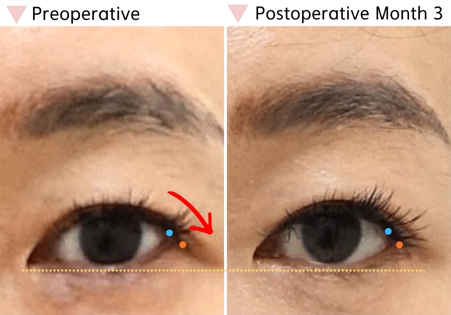 Preoperative and postoperative month 3 comparison demonstrating downward repositioning of the lateral canthus and improved eye shape balance after dual canthoplasty
