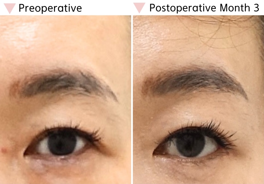 Preoperative and postoperative month 3 comparison after lateral canthoplasty showing a longer and more balanced eye shape
