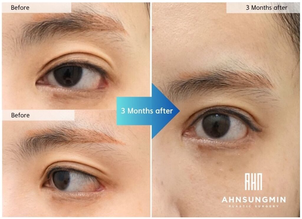 Before and 3-month postoperative lateral canthoplasty revision results at Ahnsungmin Plastic Surgery Korea showing improved outer corner stability and more natural eye balance.