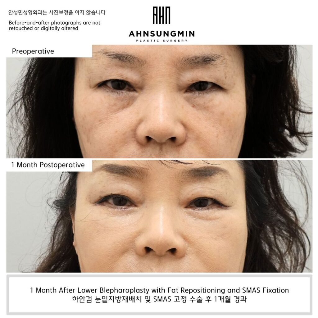 Lower blepharoplasty 1 month recovery after fat repositioning and SMAS fixation in Korea