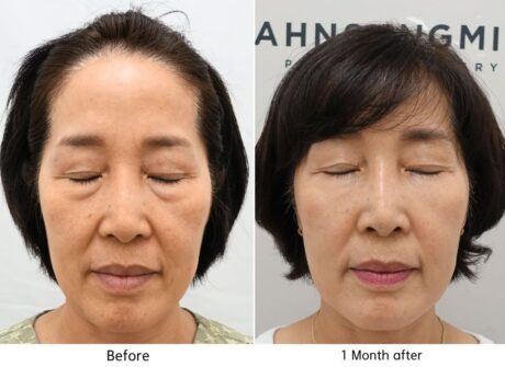 Why Midface Support Matters in Lower Blepharoplasty