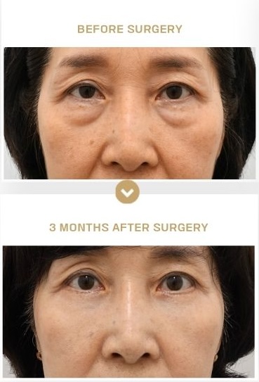 Lower blepharoplasty before surgery and 3 months after surgery in Korea