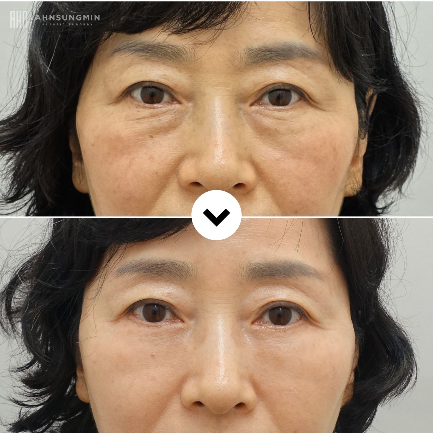 Before and after lower blepharoplasty in Korea showing reduced under-eye bags and natural facial rejuvenation