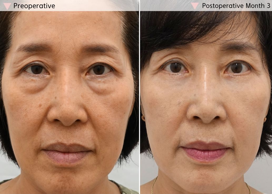 Lower blepharoplasty before and after by an eyelid surgery specialist in Korea