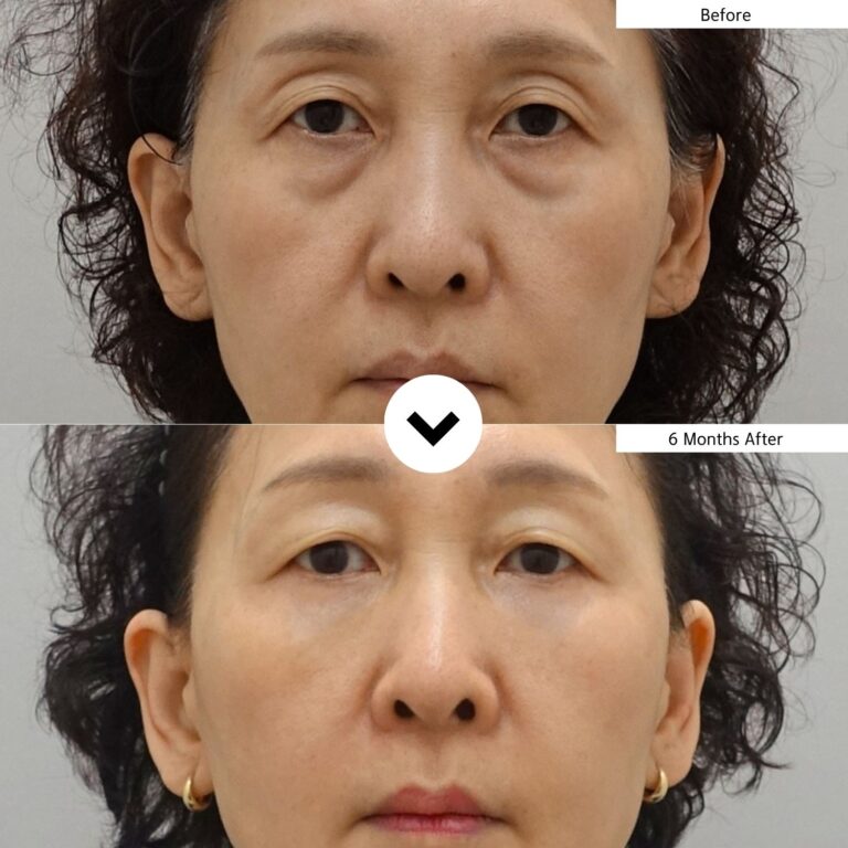 Lower blepharoplasty before and after in a middle-aged woman at 6 months