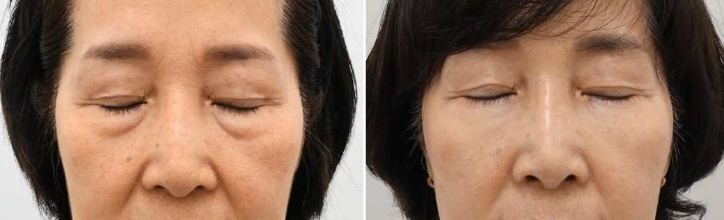 Eyes closed comparison after lower blepharoplasty with fat repositioning and SMAS fixation in a woman in her 60s showing improvement of lower eyelid bags and contour irregularities