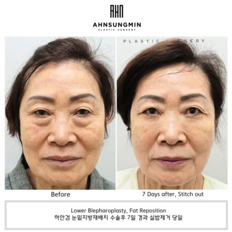 Not Every Wrinkle Should Be Removed After Lower Eyelid Surgery