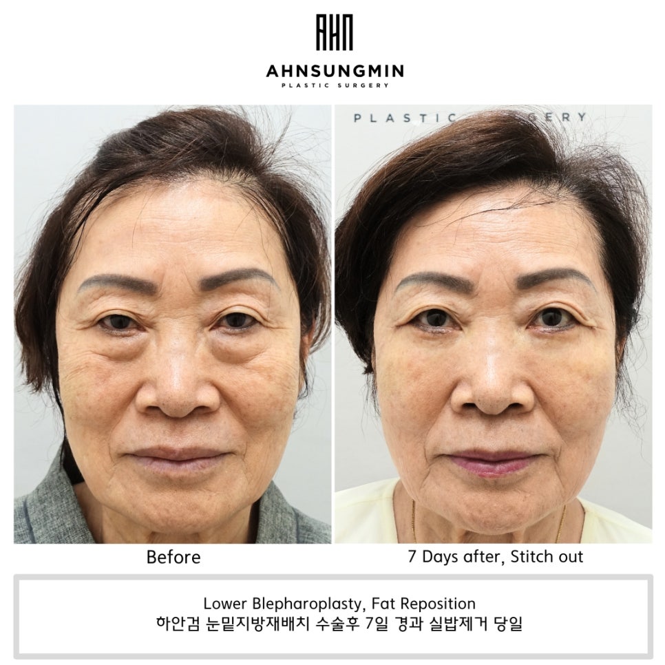 7 days after lower blepharoplasty and fat repositioning in Korea showing early recovery after stitch removal