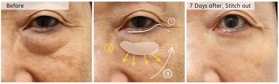 diagram explaining lower blepharoplasty fat reposition and midface support technique in Korea
