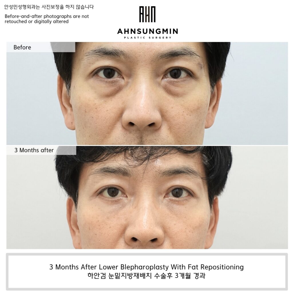 Before and 3 months after lower blepharoplasty with fat repositioning showing improvement of under-eye bags and smoother lid-cheek transition.