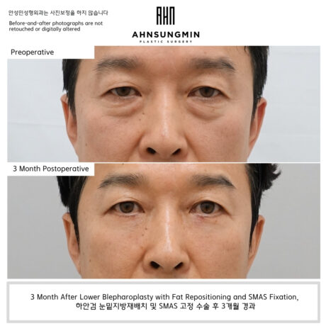 Why Good Lower Eyelid Surgery Should Not Make You Look Different