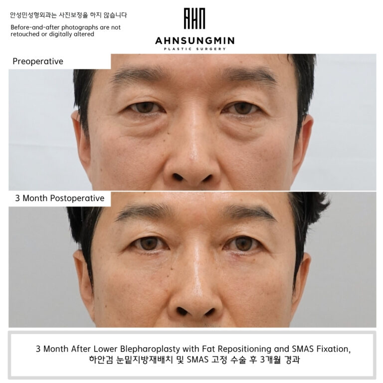 Why Good Lower Eyelid Surgery Should Not Make You Look Different