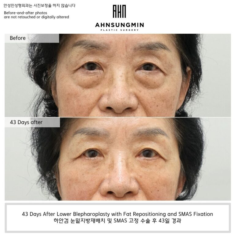 Lower blepharoplasty with fat repositioning and SMAS fixation before and 43 days after surgery in Korea