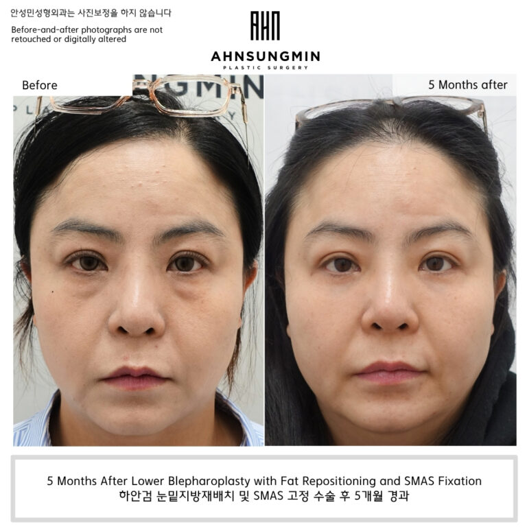 Before and 5 months after lower blepharoplasty with fat repositioning and SMAS fixation showing improvement of under-eye bags and tear trough hollowing in a woman in her 40s