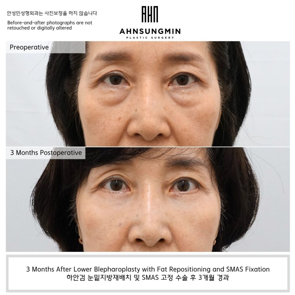 Before and 3 months after lower blepharoplasty with fat repositioning and SMAS fixation in Korea