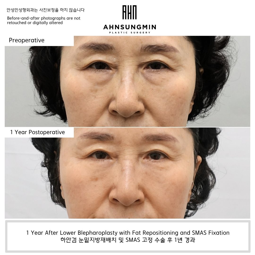 one year result after lower blepharoplasty with fat repositioning and SMAS fixation in Korea