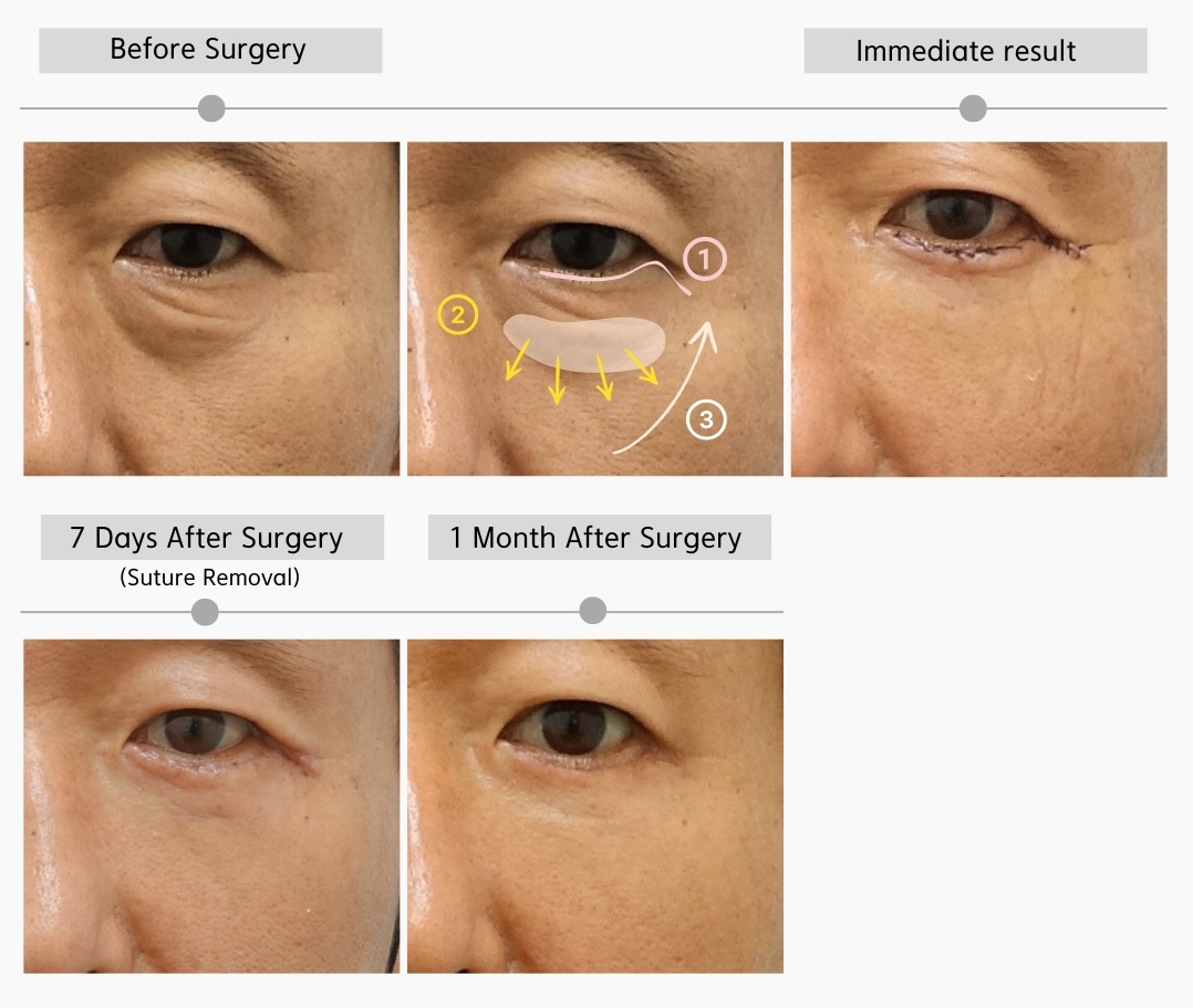 Lower blepharoplasty recovery timeline in a man in his 50s showing incision, fat repositioning, and SMAS fixation from before surgery to 1 month after surgery