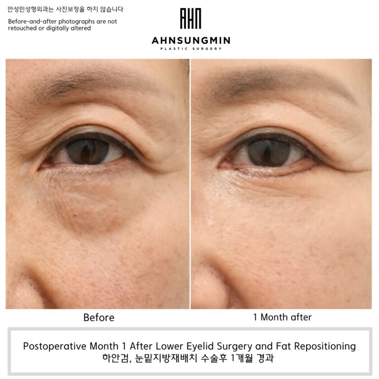 Before and 1 month after lower eyelid surgery and fat repositioning in Korea showing smoother under-eye contour while preserving natural smile lines