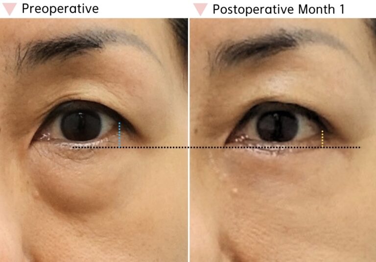 Before and 1 month after lateral canthoplasty combined with lower eyelid surgery in Korea showing improved lateral eye contour and lower eyelid support