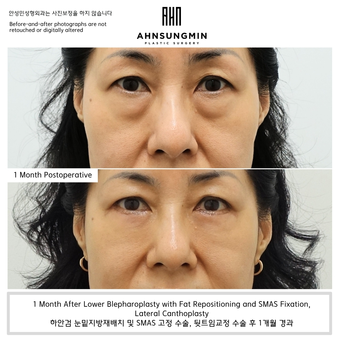 One month after lower blepharoplasty with fat repositioning, SMAS fixation, and lateral canthoplasty in Korea showing smoother under-eye contours and improved lateral eye shape