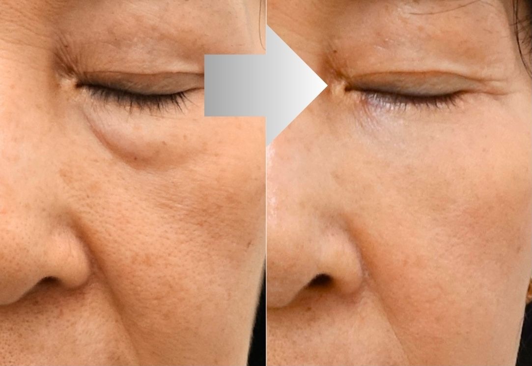 Lower blepharoplasty with midface rejuvenation before and after in Korea
