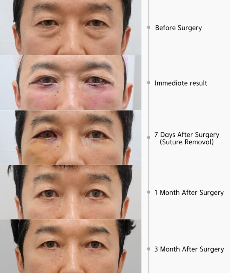 Lower blepharoplasty recovery timeline in Korea showing before surgery, immediate postoperative appearance, day 7 after suture removal, month 1 recovery, and month 3 postoperative results