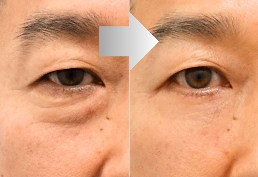 Lower blepharoplasty for severe eye bags and wrinkles before and after in Korea