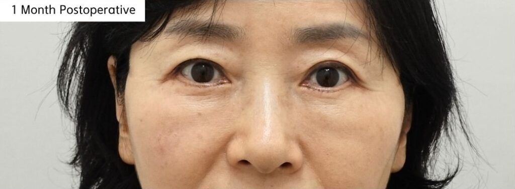 lower eyelid 1 month after surgery early improvement in contour after fat repositioning with mild residual swelling